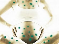 norice v nosečih simptomih
