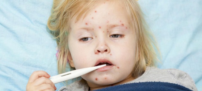 как да се лекува варицела при децата