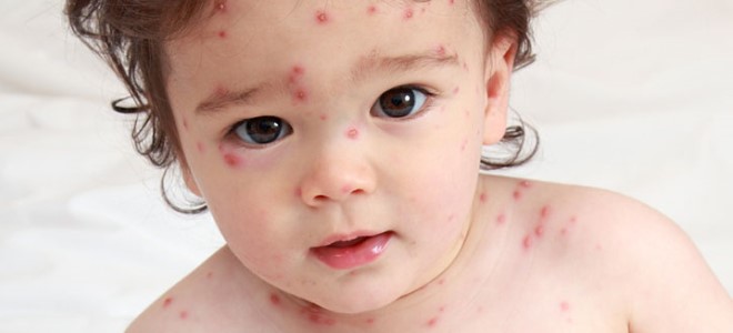 příznaky neštovice u dítěte