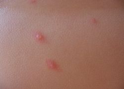chickenpox u simptomima dojenčadi