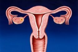 przewlekłe leczenie endometritis 1