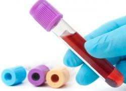 kronična limfocitna levkemija krvni test