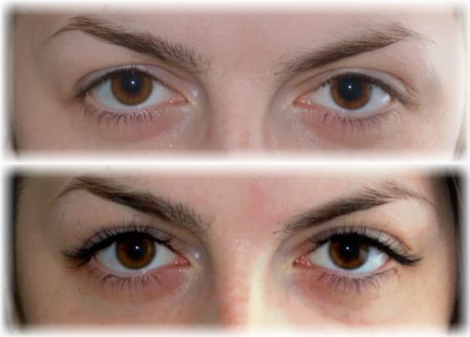 klasické rozšíření oka před a po skončení1