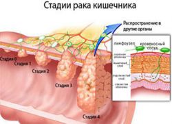 етапи на рак на дебелото черво