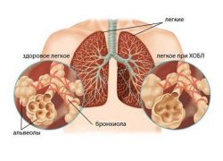 Prognózu COPD