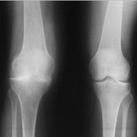 koaxartrózou symptomů kolenního kloubu