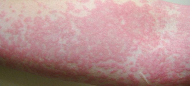 Как проявляется аллергия на коже крапивница
