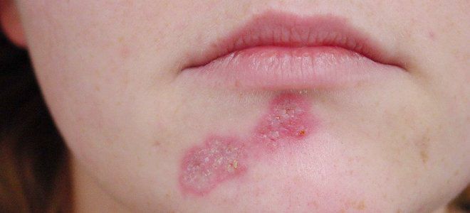 Как проявляется аллергия на коже нейродермит