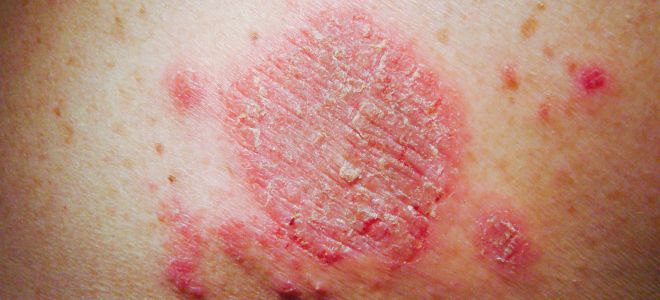 Как проявляется аллергия на коже экзема