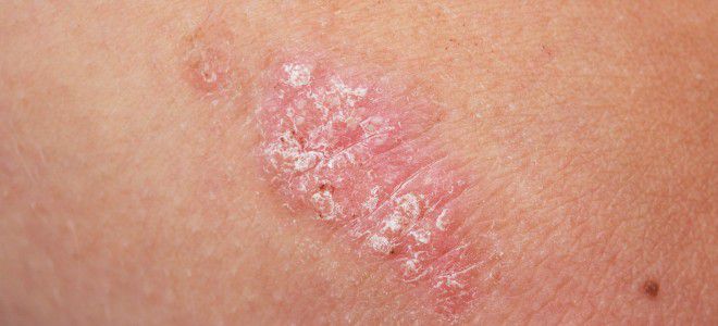 Как проявляется аллергия на коже контактный дерматит