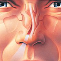 skrzywienie przegrody nosowej