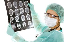 zdravljenje z zdravili za ciste na možganih