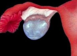 Cystadenoma на левия яйчник