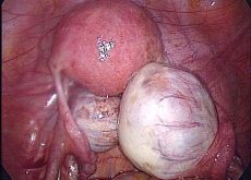 operace cystomu pravého vaječníku