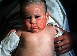 цитомегаловирусна инфекција код деце изазива