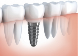 indikacije in kontraindikacije za zobno implantacijo