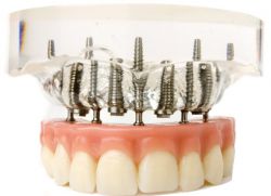 implant dentystyczny