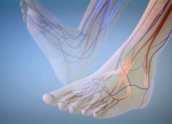 vaskularna bolest nogu