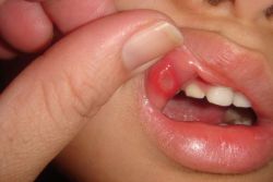vnetne bolezni ustne sluznice