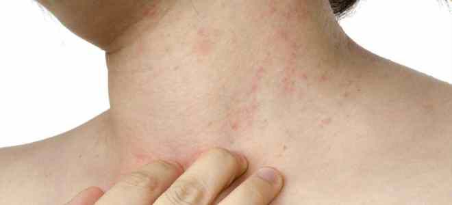 Кожные заболевания на теле аллергический дерматит