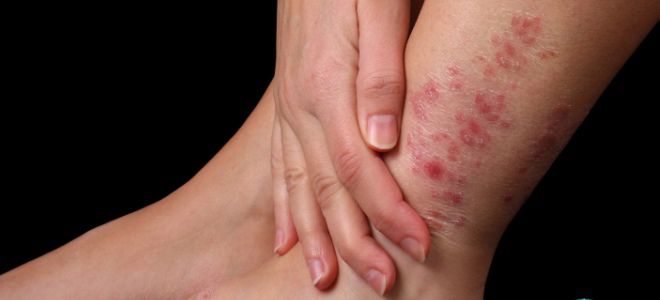 Кожные заболевания на ногах дерматит
