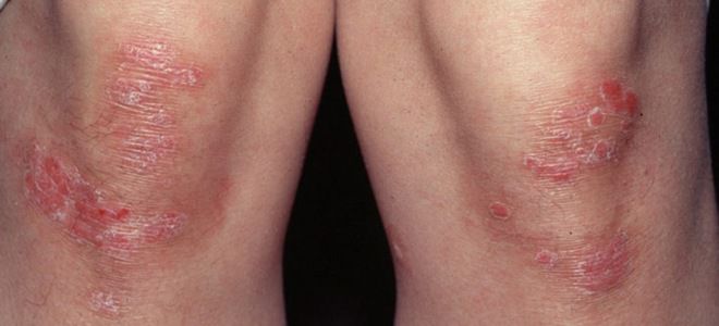 Кожные заболевания на ногах псориаз