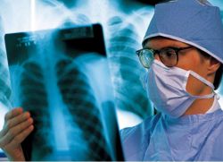 razširjeno zdravljenje pljučne tuberkuloze