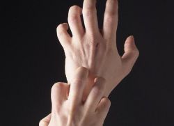 дисхидрозна екзема на ръцете