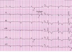 objawy EKG zawału mięśnia sercowego
