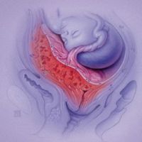 marginal placenta previa 20 týdnů