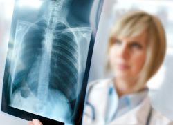 X-ray znak rozedma płuc