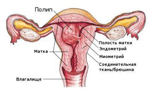 endometrialny polip gruczołowy