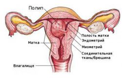 glandularnega polip endometrija