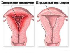 ендометриална дебелина при менопаузата