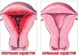 Metode zdravljenja hiperplazije endometrija