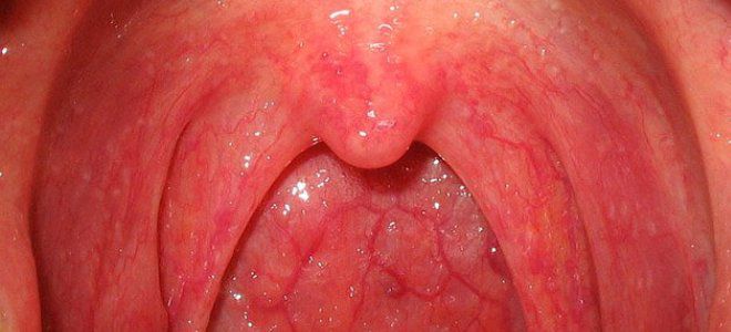Энтеровирусная инфекция у детей сыпь горло