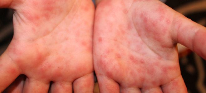 Энтеровирусная инфекция у детей сыпь руки