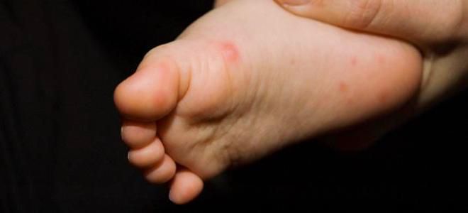 Энтеровирусная инфекция у детей сыпь ноги