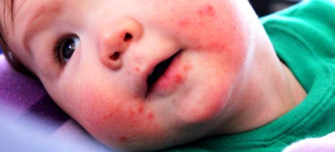 Энтеровирусная инфекция у детей сыпь рот