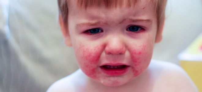 Энтеровирусная инфекция у детей сыпь экзантема