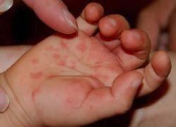 okužba s enterovirusom pri otrocih