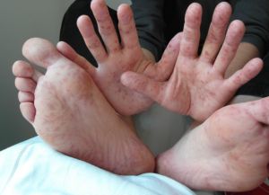 kožni izpuščaj na dlani in stopalih