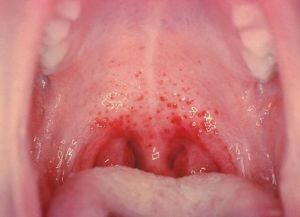 enterovirusna lezija v grlu in izpuščaj