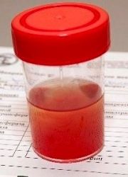 kaj pomeni eritrocit v urinu