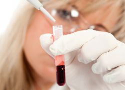 Povišan krvni test fibrinogena