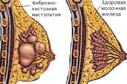 příznaky fibrocystické mastopatie