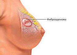 ošetření lidských léků pomocí fibroadenomu prsu