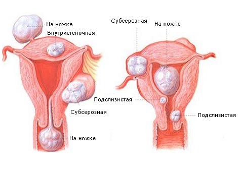 Symptomy fibrózy u dělohy