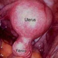odstranění děložního fibrómu