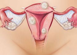 fibromatoza v telesu maternice